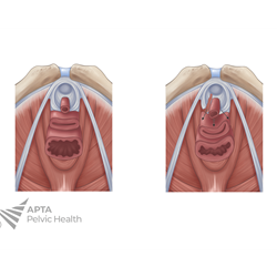 Urethral Prolapse