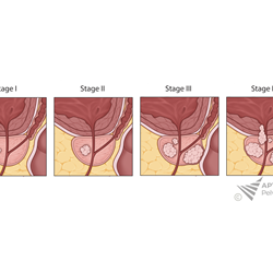 Prostate Cancer Stages
