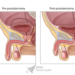 Post Radical Prostatectomy