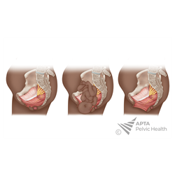 Circumferential and Downward Levator Ani with Nerve Stretching