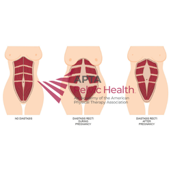 Diastasis Recti