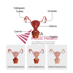 Hysterectomy