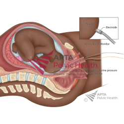 Internal Fetal Monitoring