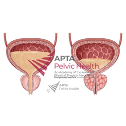 Normal vs Bladder Outlet Obstruction