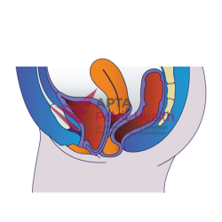 Pelvic Organ Prolapse