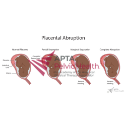 Placental Abruption