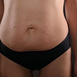 Assessing Postpartum Conditions: Diastasis Recti & Incontinence