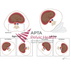 Supine Hypotensive Syndrome